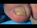 Double ingrown toenail treatment