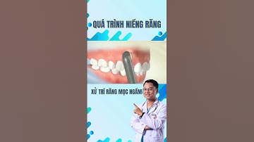 Quá trình niềng răng XỬ TRÍ RĂNG MỌC NGẦM #drcuong #nhakhoa #niengrang