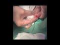 ⑧ 粉瘤くりぬき法 epidermal cyst atheroma cystic acne extraction 脂肪腫 lipoma クリニーク大阪心斎橋　大阪梅田院　名古屋栄院　福岡天神院　三宮院