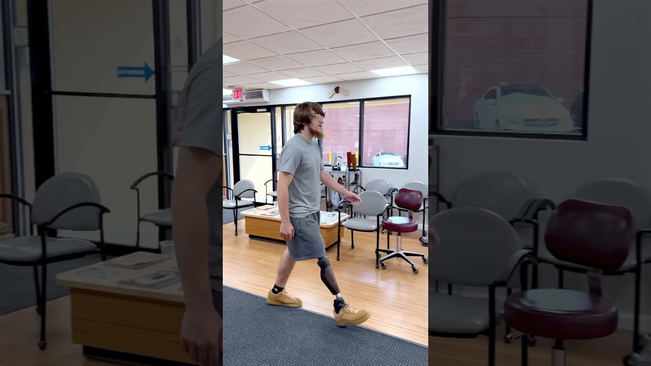 Max walking with Above Knee Prosthetic Leg