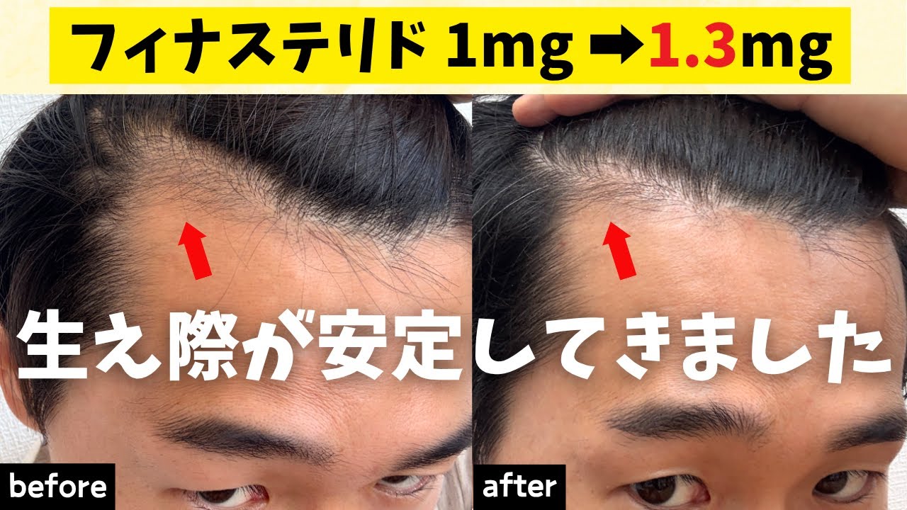 【薄毛・AGA】フィナステリド1mg→1.3mgで生え際（ヘアライン）が安定してきました、、、