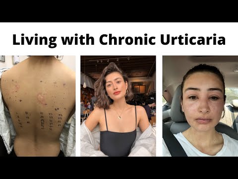 Living with Chronic Urticaria - My First Flareup + Q&A | Autoimmune Chronic Hives | Chronic Illness