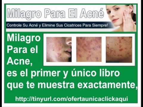 Remedios Para Acne En La Espalda, como curar el acne rapido, .wmv