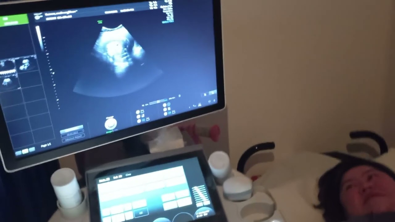 3d ultrasound 