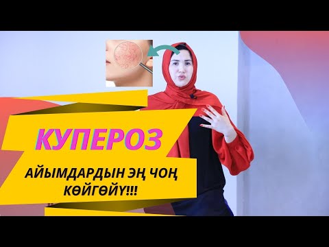 Video: Саркоидоз менен кантип күрөшүү керек: 8 кадам (сүрөттөр менен)