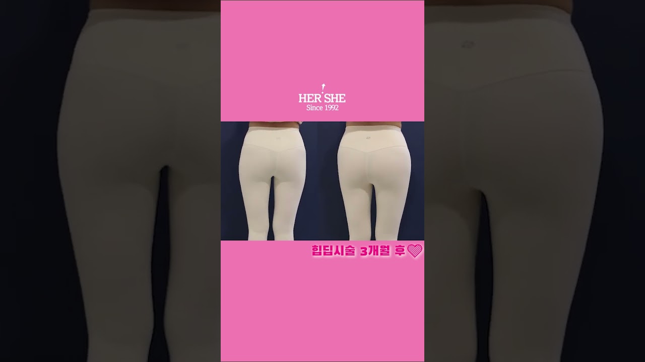 [Хэрши гоо сайхны мэс заслын эмнэлэг] Өгзөг өргөх лифтинг #шоортс #хондлойны_хонхорхой #өгзөг_өргөх #өгзөг_өргөх_мэс_засал