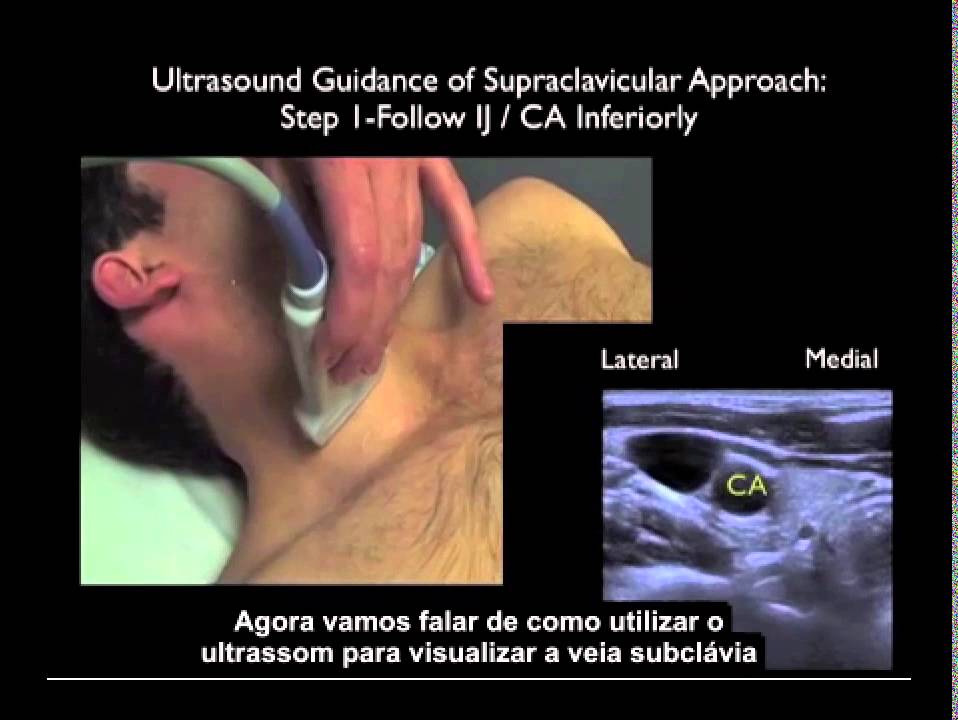 Acesso Vascular - EDU00694 Abordagem Supraclavicular na Canulação Subclávia com Ultrassom SonoSite