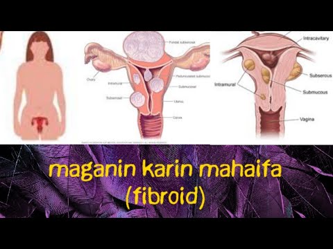 MAGANIN KARI   (fibroid /ovarian) + (ciwon da yake tsirowa mata a mahaifa