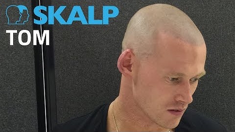Scalp Micropigmentation Testimonial by Skalp® Tom Lindley’s video