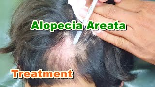 Alopecia Areata Treatment by ILS (Intralesional Steroid) Injections | Triamcinolone Acetonide
