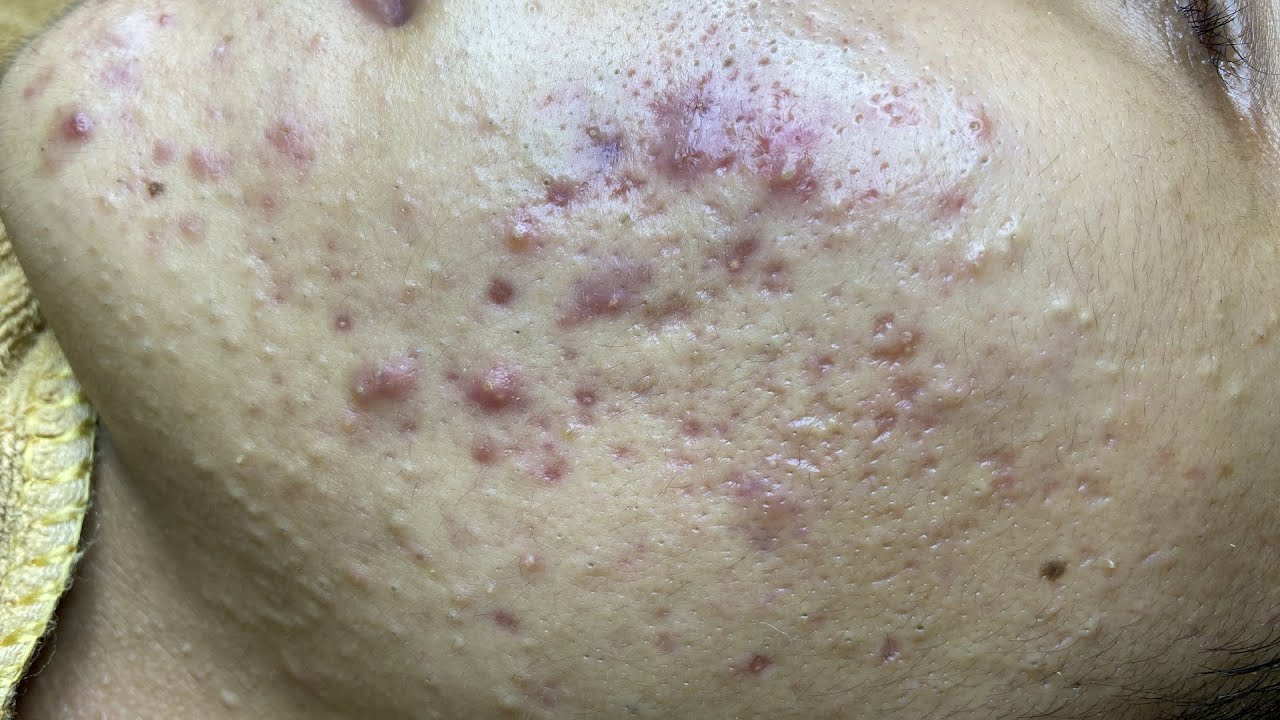 Acne Treatment For Cuong (P1)| Điều Trị Mụn Cho Cường P1 - SacDepspa#246