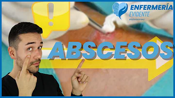 ¿Cómo hacer que drene un absceso?