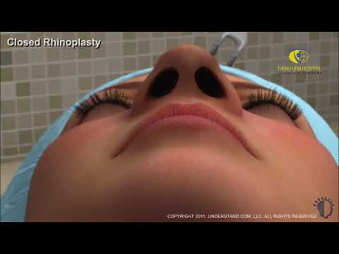 3D quy trình phẫu thuật nâng mũi tại bệnh viện thẩm mỹ Thanh Vân 3D quy trình phẫu thuật nâng mũi tại bệnh viện thẩm mỹ Thanh Vân