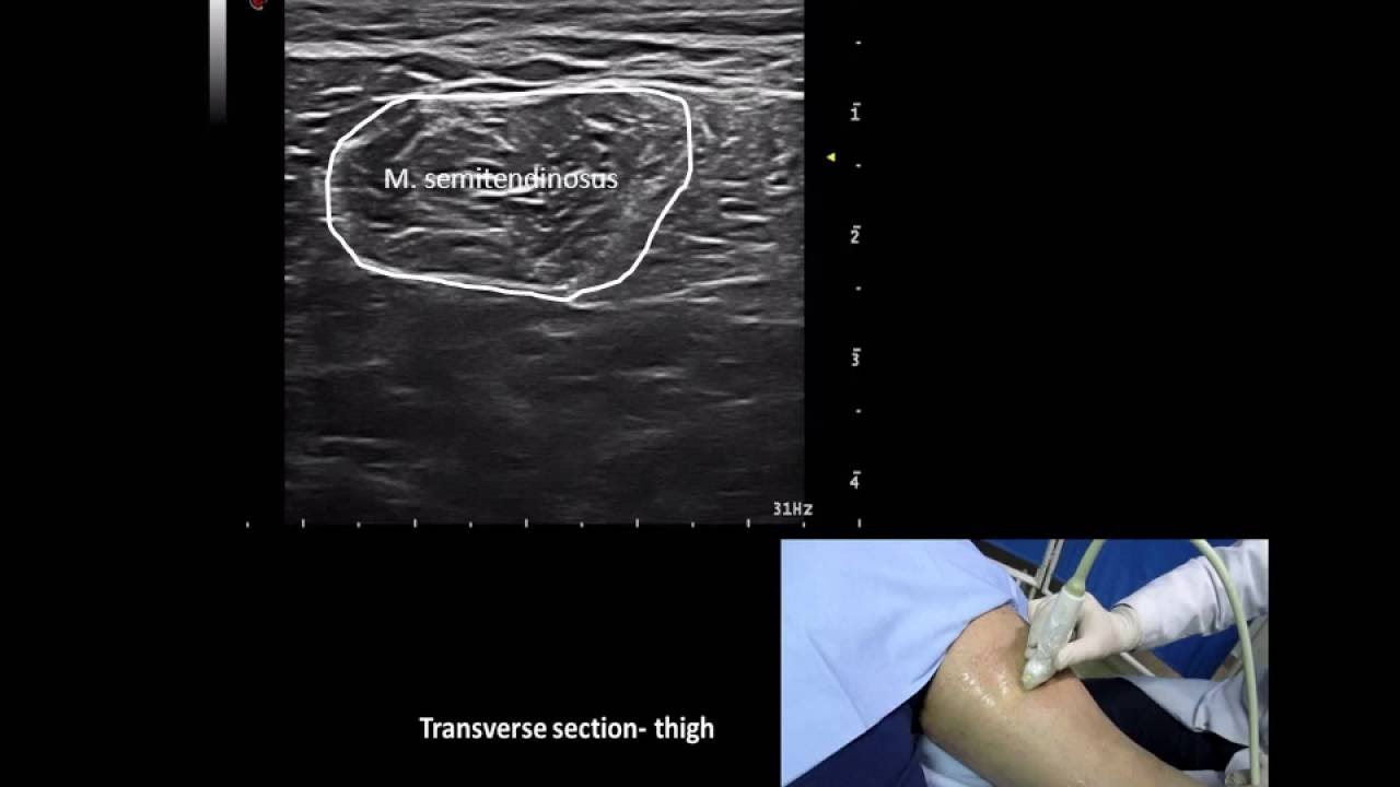 Ultrasound guided thigh botulinum toxin injections, by Murat Karkucak