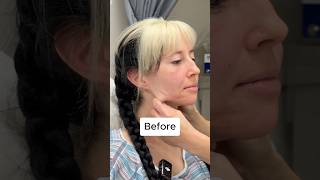 Endoscopic Deep Plane Facelift Transformation - 6 Week Update