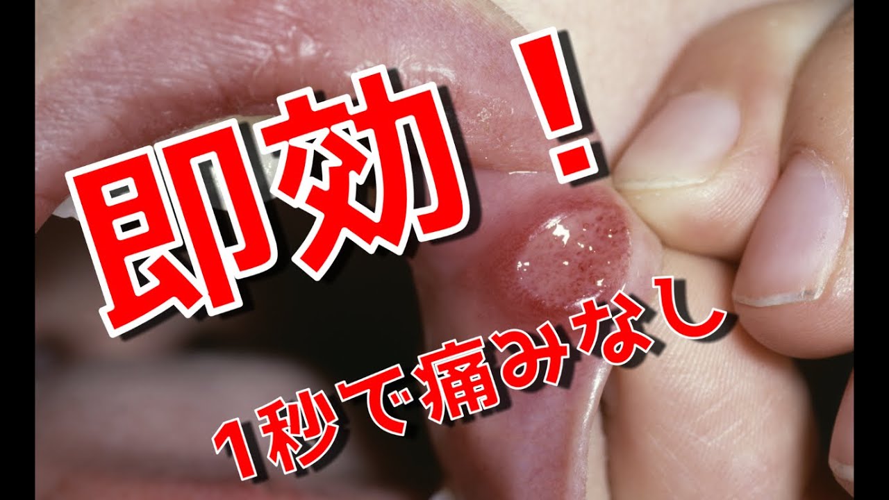 ベロ の 下 の 口内炎 治す 方法