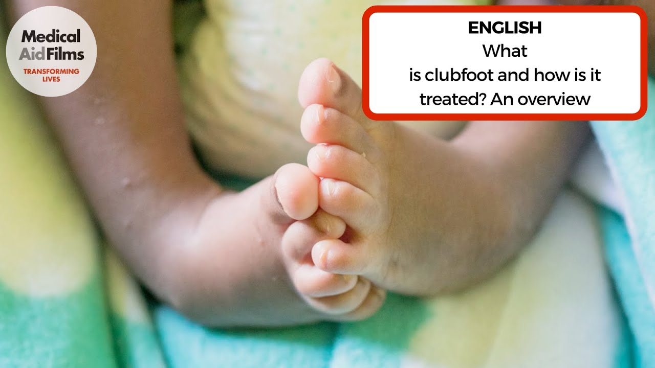 What Is Clubfoot And How Is It Treated An Overview Youtube
