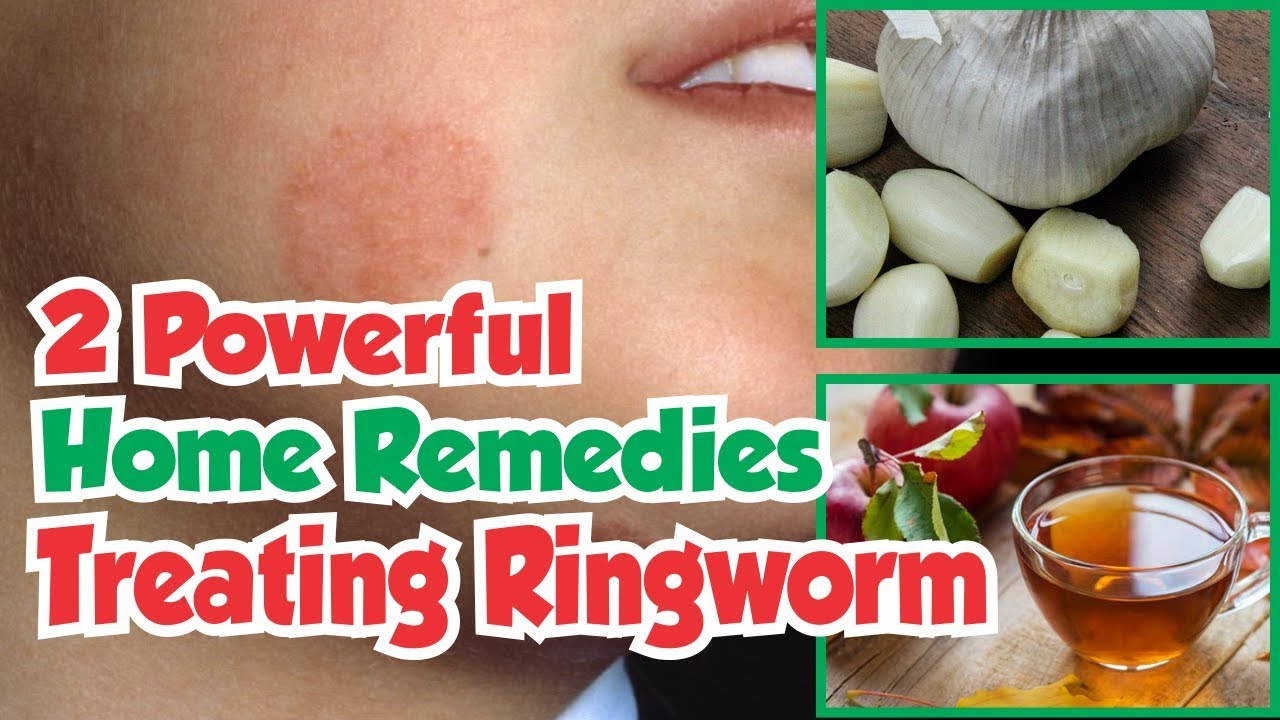 The Restorative Term For Ringworm