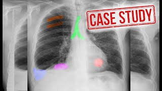 Retrocardiac mass | CXR cases | حالات سريرية عن صور الصدر البسيطة | Azigo-esophageal recess