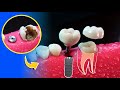 ¿Qué es mejor una endodoncia o un implante?