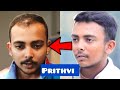 Prithvi Shaw|Hair transplant| Results| Minoxidil| Finasteride| hair fall| hindi| receding|regrowth