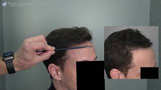 Natural Hairline Result - 2024 Grafts From Dr. Cooley - 4K Ultra HD