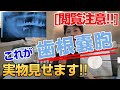 [閲覧注意] 歯根嚢胞の実物がこれだ★歯の根っこの病気,根尖性歯周炎,根尖病巣,根管治療,嚢胞摘出,のう胞,レントゲンの透過像