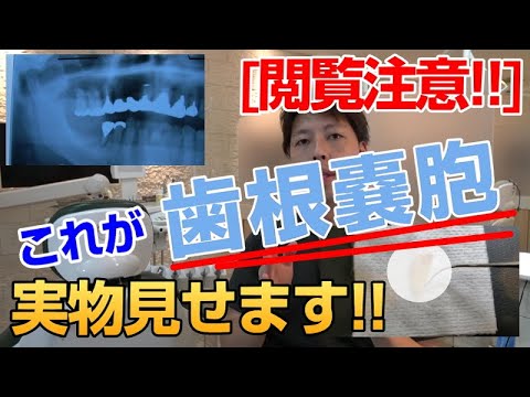 [閲覧注意] 歯根嚢胞の実物がこれだ★歯の根っこの病気,根尖性歯周炎,根尖病巣,根管治療,嚢胞摘出,のう胞,レントゲンの透過像