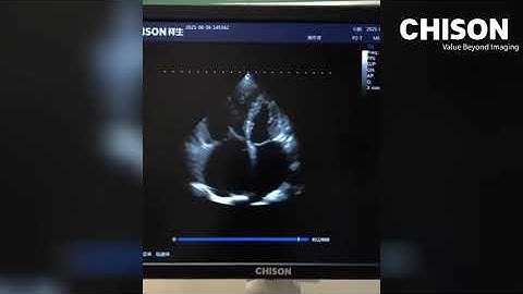 CHISON XBit 90 in Cardiac Scanning