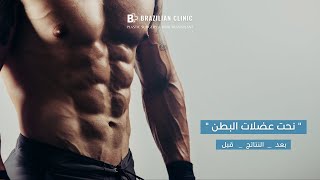 عضلات البطن (six pack) نحت وتجميل  نتائج مضمونة