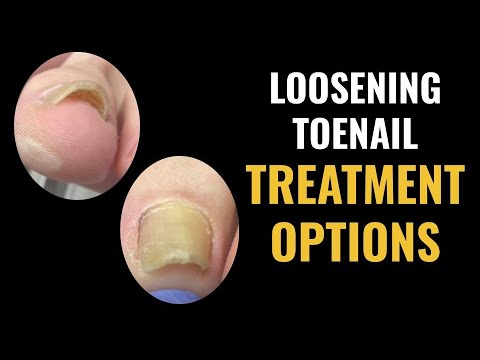 Loosening toenail - Options for treatment