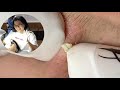 Acne Treatment Huong Da Nang#604 _ 2024  #blackheads