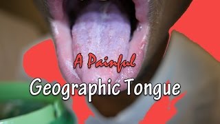 A Painful Geographic Tongue