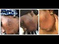 7 DAYS TURMERIC FACE MASK CLEARED MY ACNES AND HYPERPIGMENTATION| BEFORE AND AFTER IN THE VIDEO