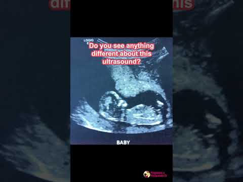 Video: Ukáže sa záhadné tehotenstvo na ultrazvuku?