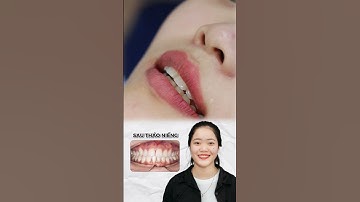 Tháo niềng răng khấp khểnh