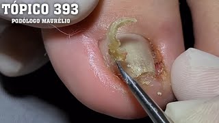A FAMOSA UNHA EM FORMATO DE U ( NAIL'S LOVERS )#PODOLOGOMAURELIO #PODOLOGIA#UNHAENCRAVADA