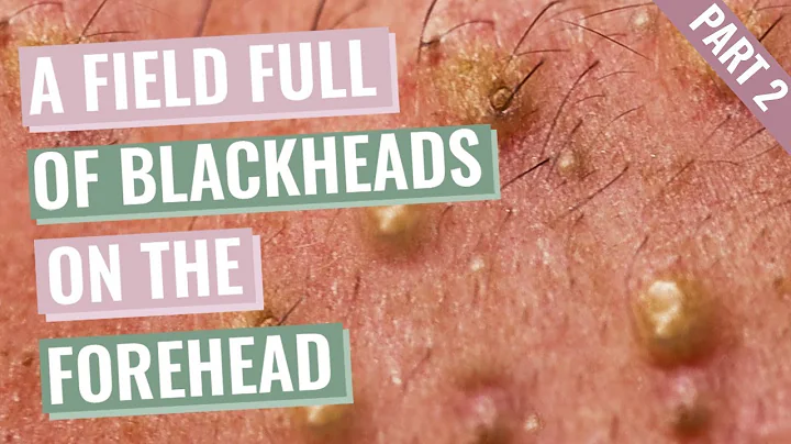 A Field Full of Blackheads on Aimilios’s Forehead and eyebrows - Part 2 out of 4 - DayDayNews