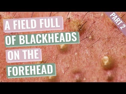A Field Full of Blackheads on Aimiliosâs Forehead and eyebrows - Part 2 out of 4