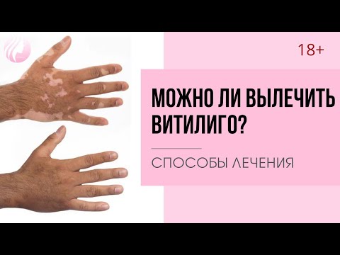 ЛЕЧЕНИЕ ВИТИЛИГО. КАК и ЧЕМ лечить витилиго. Способы лечения белых пятен на теле