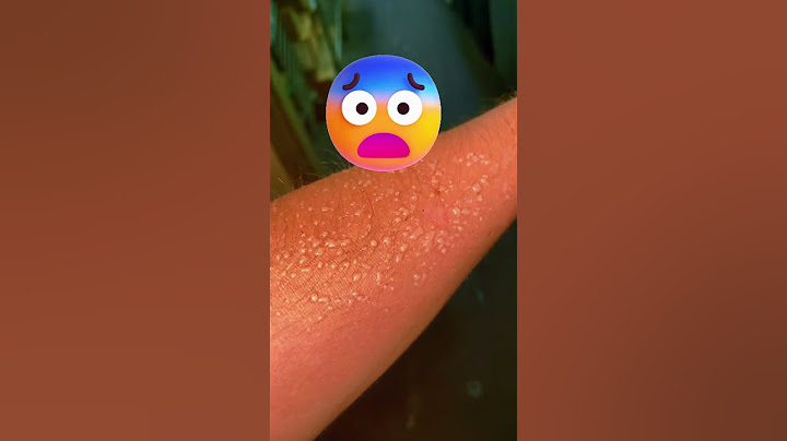 Направете ТОВА, ако получите слънчево изгаряне! 😨