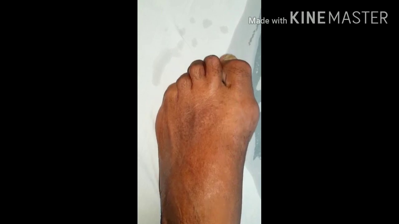 Hammer toe YouTube