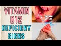 7 Signs you Have Vitamin 12 Deficiency