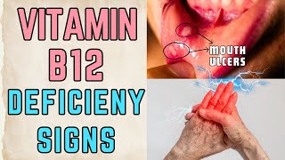 7 Signs you Have Vitamin 12 Deficiency