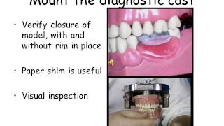 Mount the RPD diagnostic casts