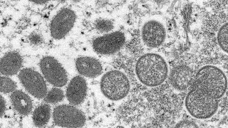 First probable cases of monkeypox reported in Marion County