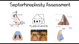 Septorhinoplasty Assessment - FRCS ENT Exam Essentials