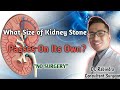 Kidney stone  what size of kidney stone passes spontaneously doctor rabindra