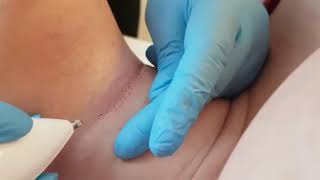 27 PLASMA PEN (ПЛАЗМА ПЕН) ОБУЧЕНИЕ МОСКВА - Курс ведет Врач дерматолог-косметолог Хуснутдинова Н.В. 27 PLASMA PEN (ПЛАЗМА ПЕН) ОБУЧЕНИЕ МОСКВА - Курс ведет Врач дерматолог-косметолог Хуснутдинова Н.В.