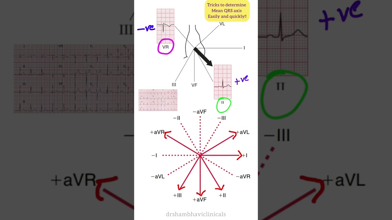 Cardiac Axis Determination: Quick & easiest tricks. 